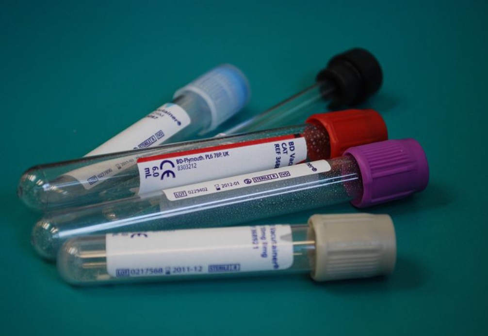 O teste para doença é realizado através de amostragem sanguínea.